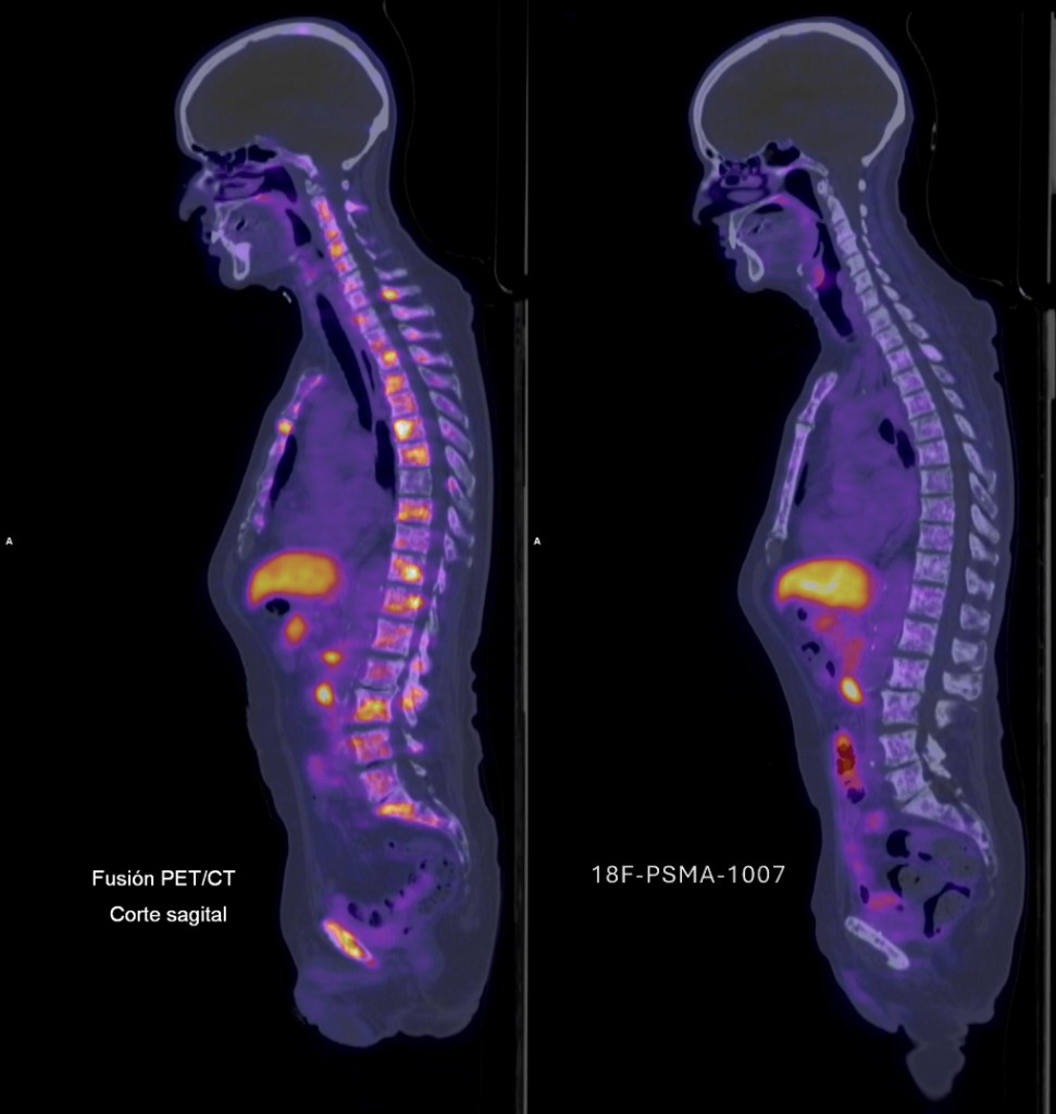 Fusión PET/CT corte sagital y 18F-PSMA-1007